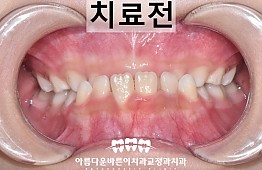 수술전