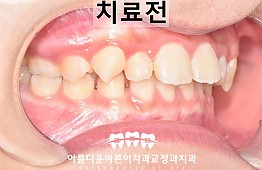 수술전