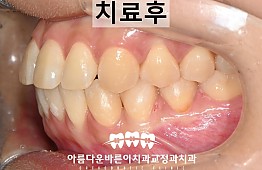 수술후