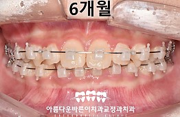 수술후