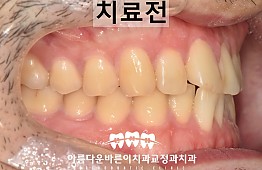 수술전