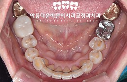 수술후