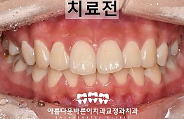 수술전