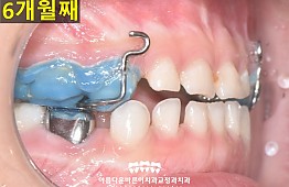 수술후