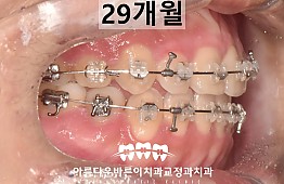 수술후