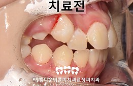 수술전