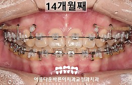 수술후