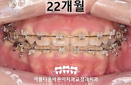 수술후