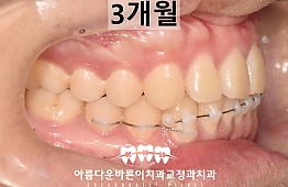 수술후