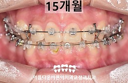 수술후