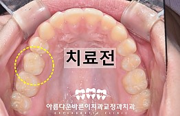 수술전