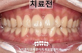 수술전