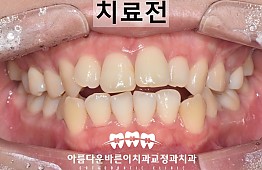 수술전