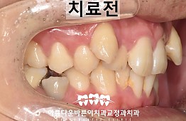 수술전