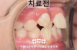 수술전