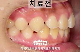 수술전