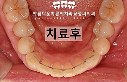 수술후