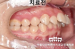 수술전