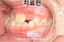 수술전