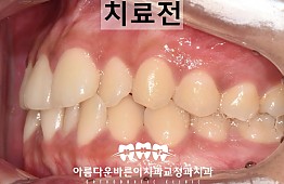 수술전