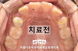 수술전