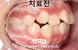 수술전