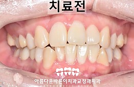 수술전