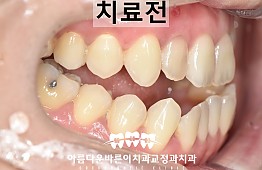 수술전