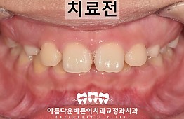 수술전