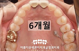 수술후