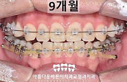 수술후