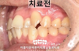 수술전