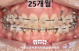 수술후