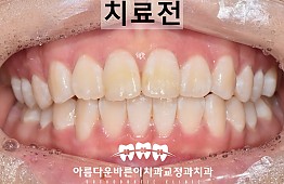 수술전