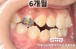 수술후