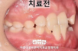 수술전