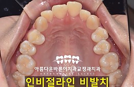 수술전