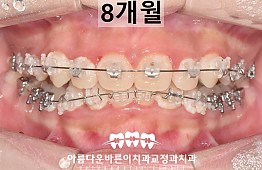 수술후