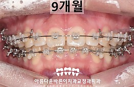 수술후