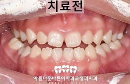 수술전