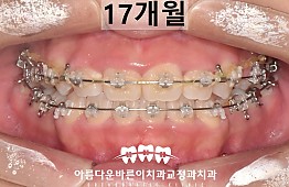 수술후