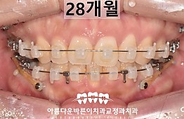 수술후