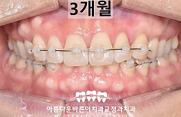 수술후