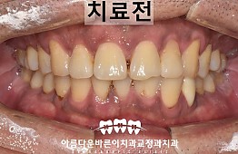 수술전