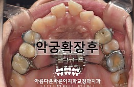 수술후