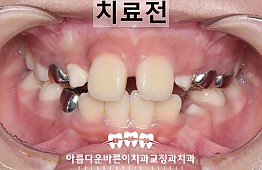 수술전