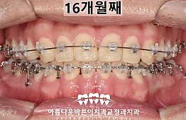 수술후