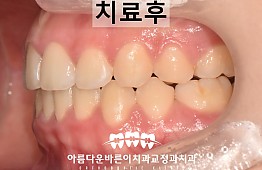 수술후