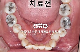 수술전