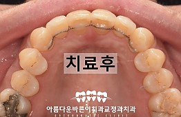 수술후